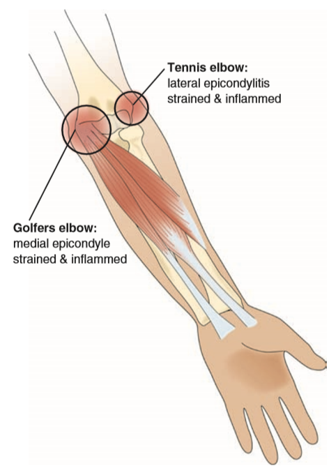 Hand Wrist Forearm And Elbow Muscle Imbalances Strong Links Fitness